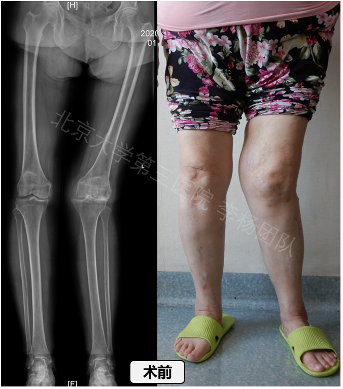 患有重度的骨性关节炎,软骨已完全磨损,膝关节外侧出现了骨对骨的接触