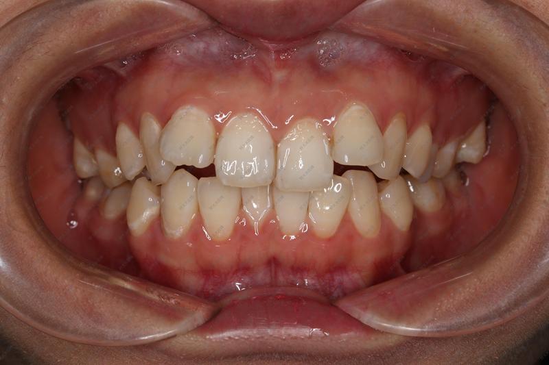 这一例没有拔牙的病例治疗前牙齿前突,方形牙弓以及牙齿重度拥挤治疗