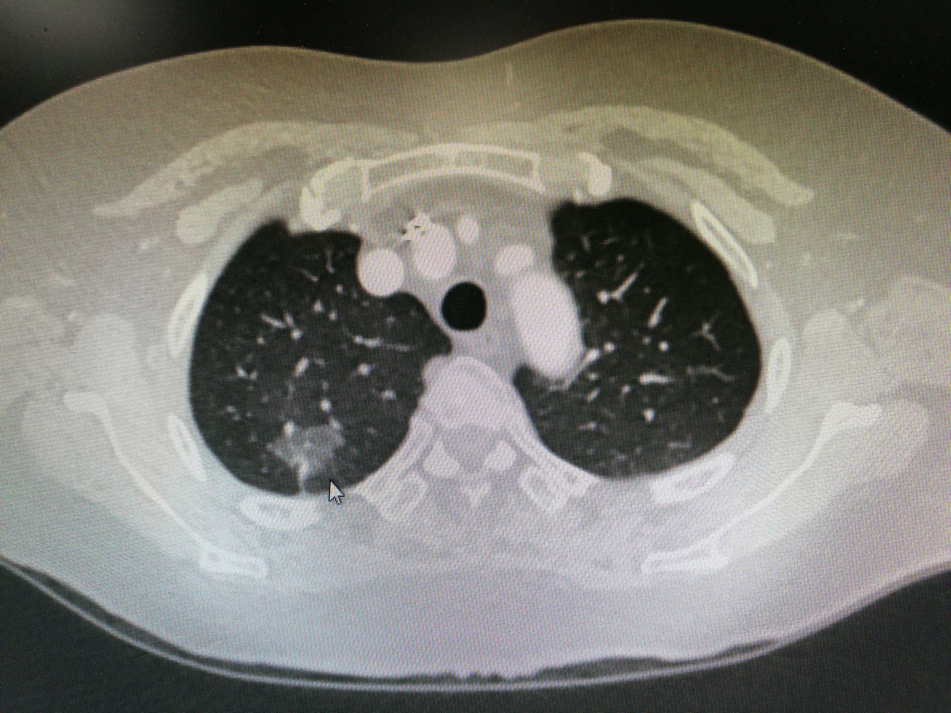 肺部结节 肺部结节