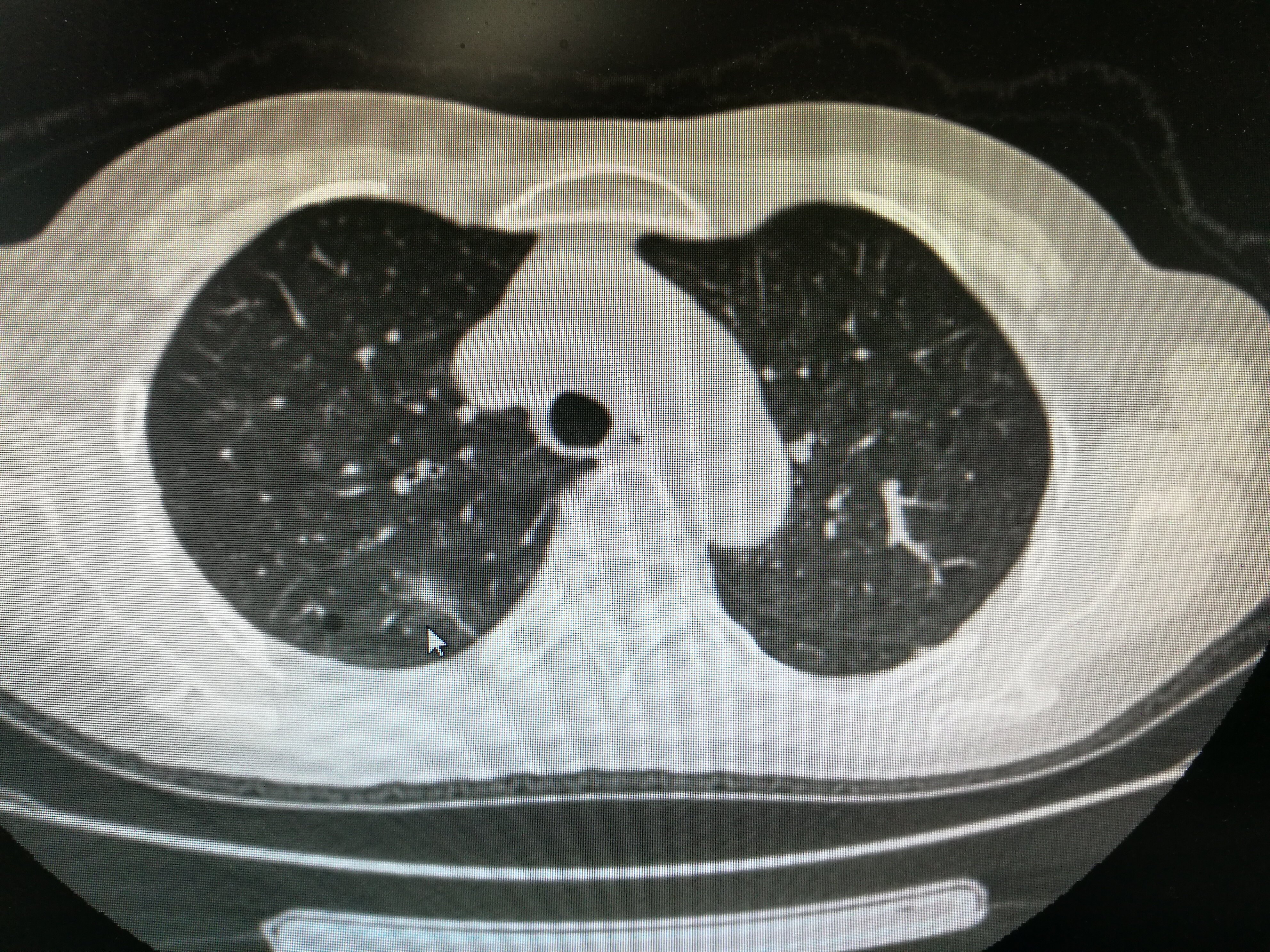 肺结节最怕三种运动较真_肺结节最怕三种运动较真_肺结节最怕三种运动较真