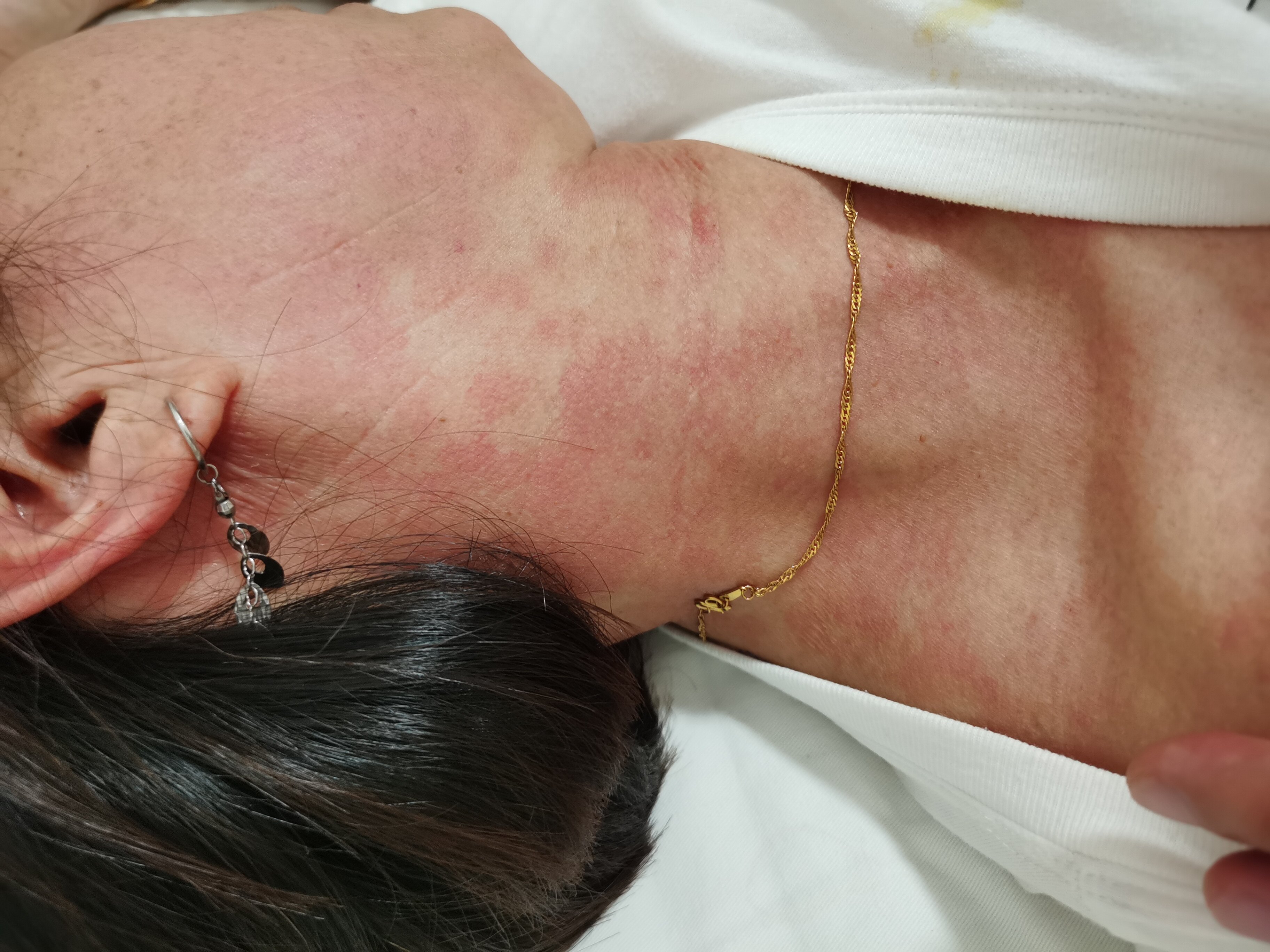 口服卵磷脂络合碘胶囊导致的药物性过敏反应及实用处理办法.