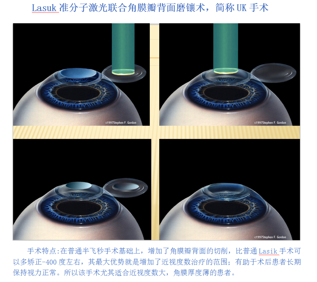 近视眼手术方式种类繁多 高度近视患者应该如何选择呢 近视眼手术 近视眼手术方式种类繁多 高度近视患者应该如何选择呢 近视眼手术
