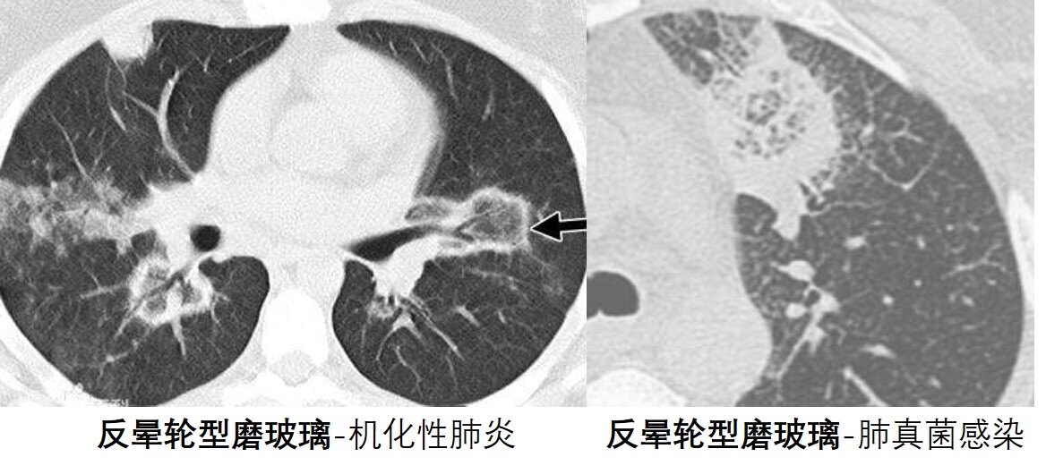 闻名戏法师患肺癌！现已手术自曝抽烟有宗族史……