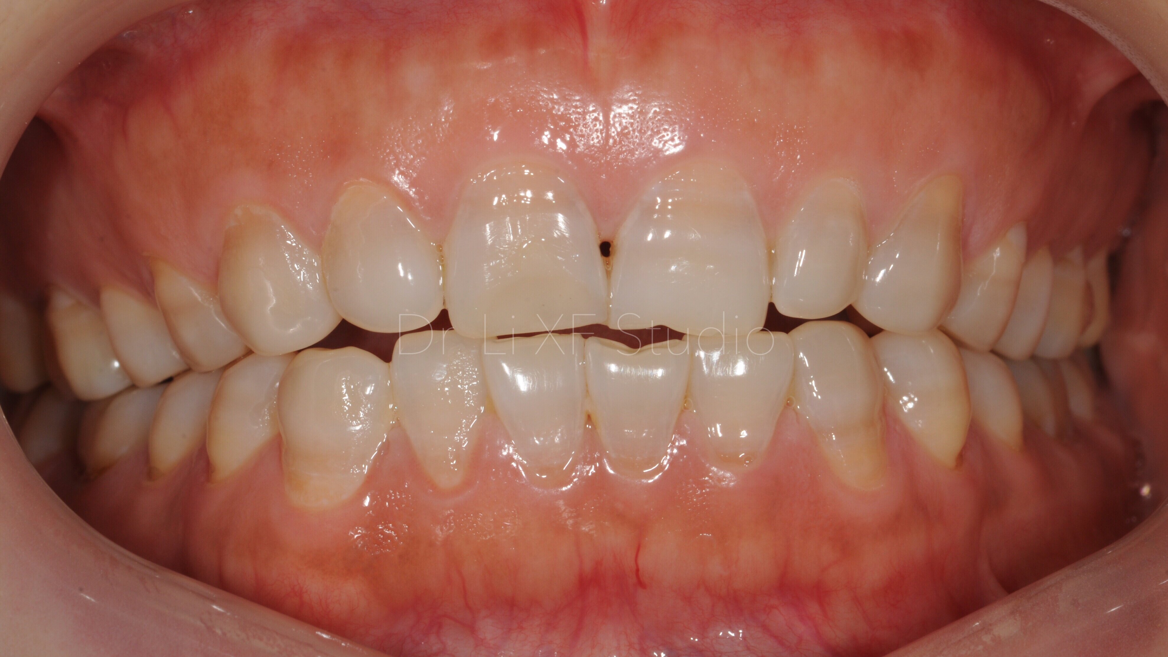 前牙美学修复_口腔修复_口腔修复治疗介绍 - 好大夫在线