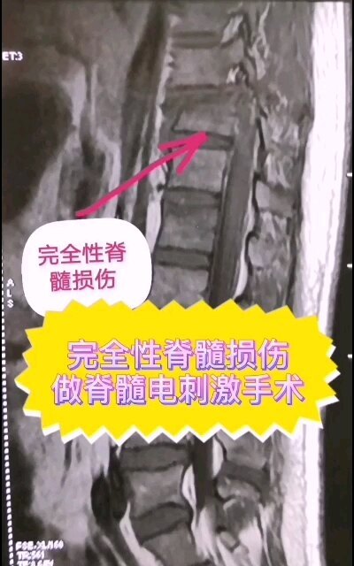 脊髓电刺激手术是瘫痪病人至今唯一的希望