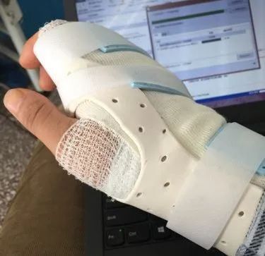 掌骨骨折支具固定对于明显移位的骨折,粉碎骨折,关节内骨折,以及开放