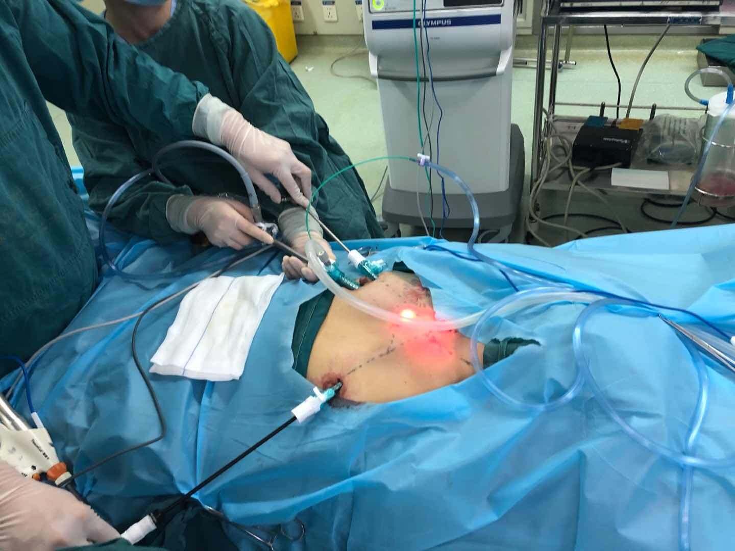 选择腔镜甲状腺,你可以颈部无痕_甲状腺结节 - 好大夫在线