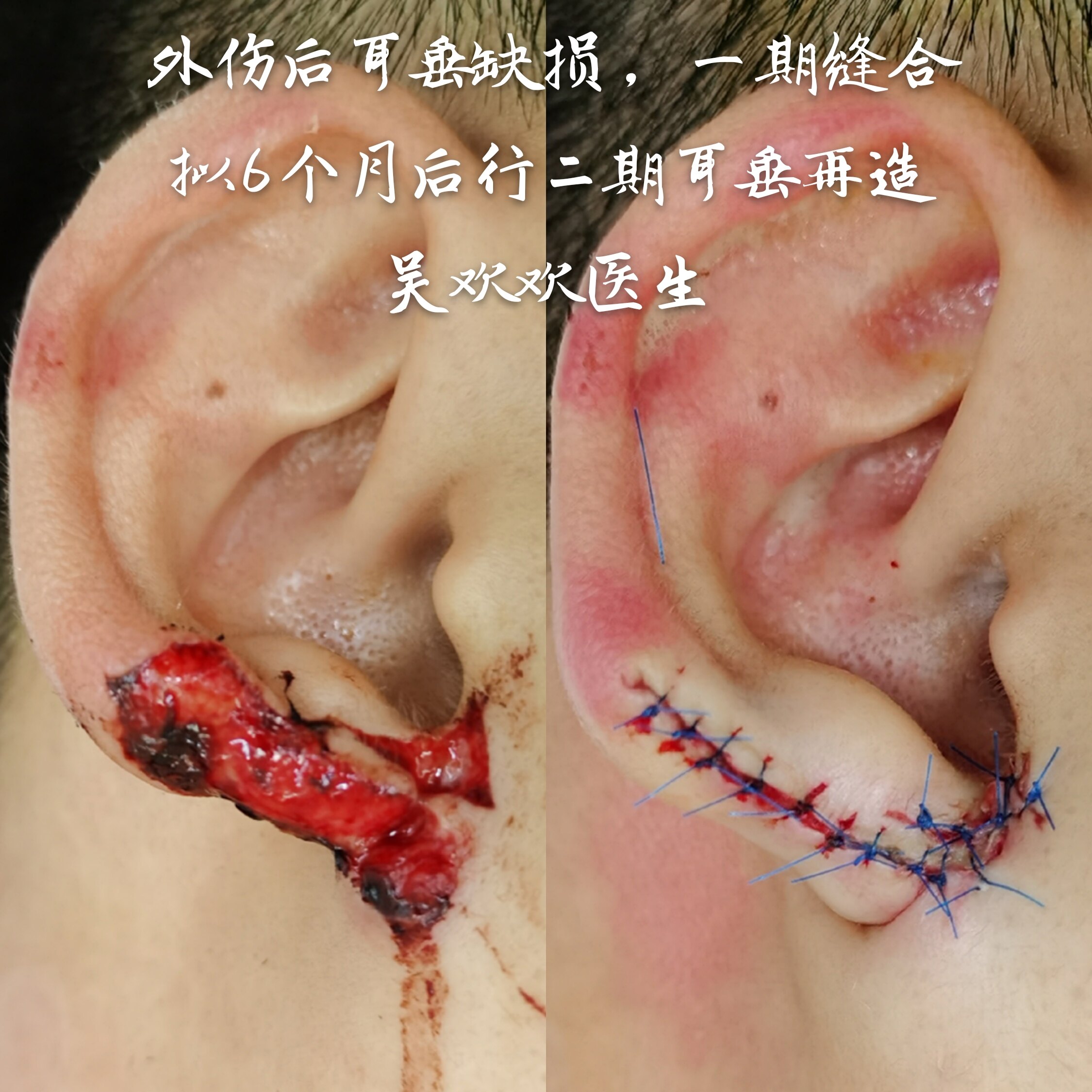 耳朵骨桥手术后图片图片