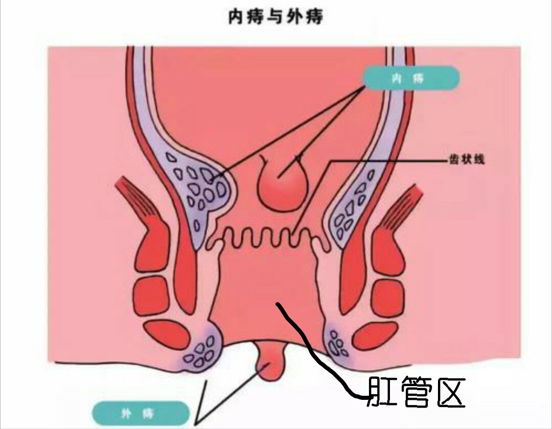 痔疮会癌变吗混合痔癌变病例一例分享