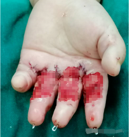 可怕的手指瘢痕挛缩一个1岁女孩的救赎之路