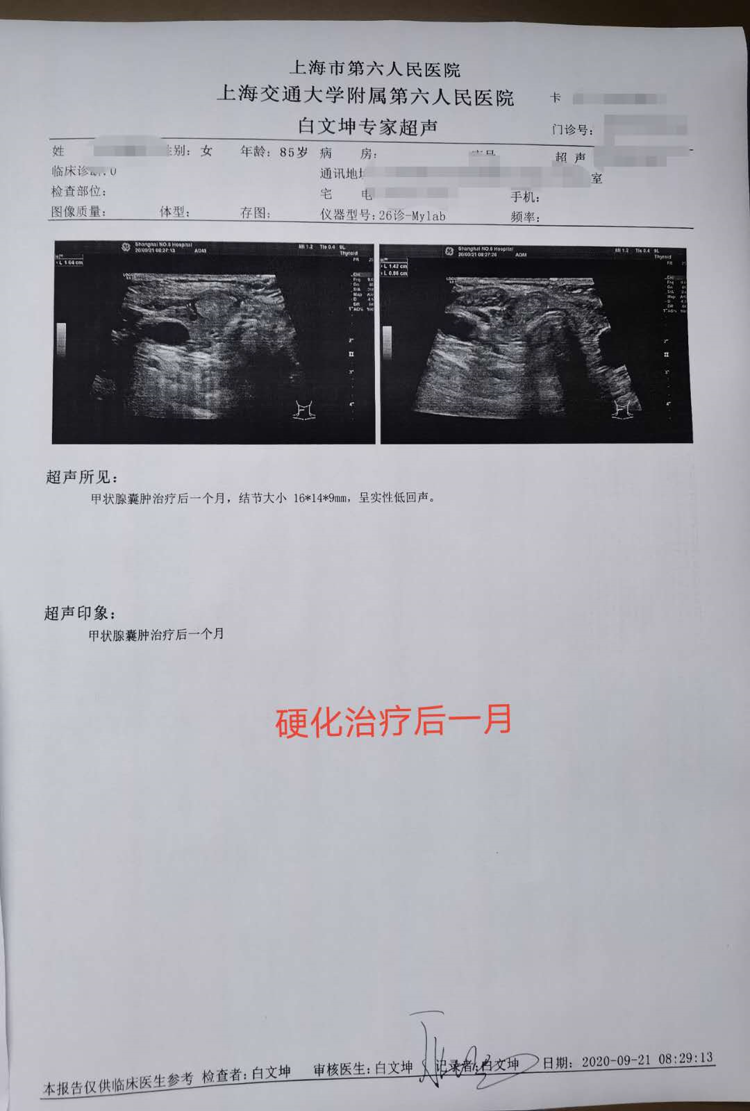 甲狀腺囊腫超聲引導下硬化治療