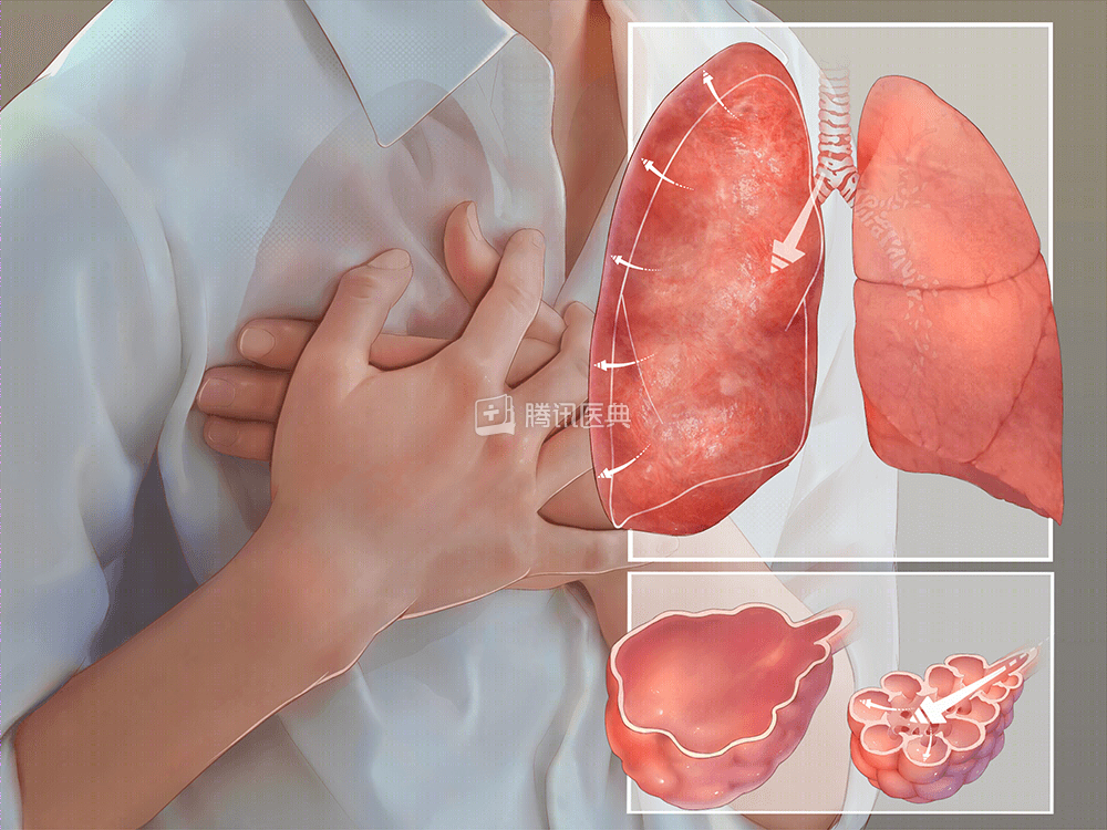 肺气肿 肺气肿 好大夫在线 肺气肿 肺气肿 好大夫在线