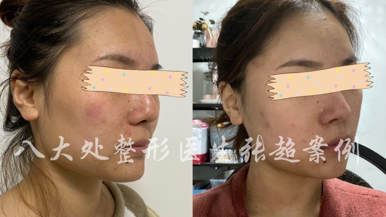 颧弓吸脂术后1个半月反馈 面部吸脂 面部吸脂 颧弓吸脂术后1个半月反馈 面部吸脂 面部吸脂