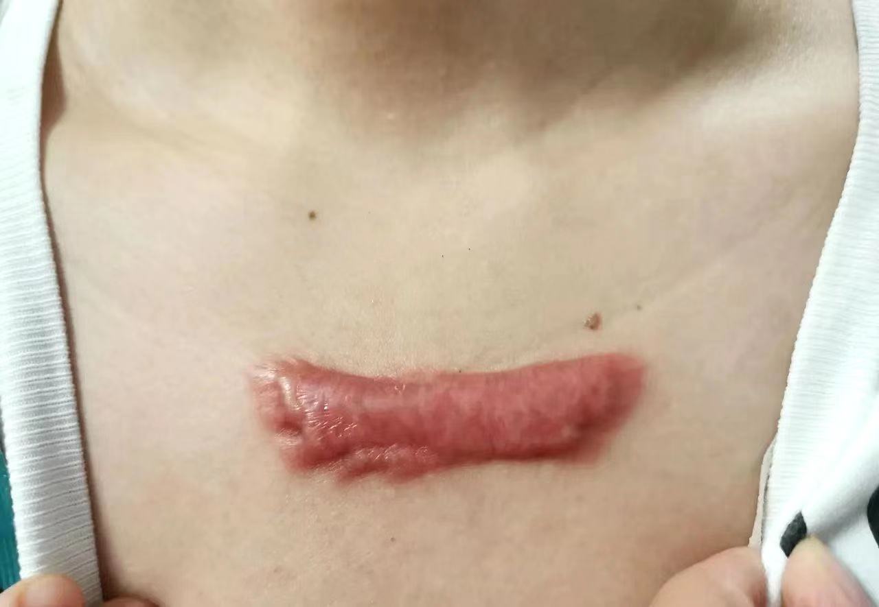 下巴一直长痤疮怎么回事?_下巴痤疮怎么治疗_下巴两侧长痤疮怎么办