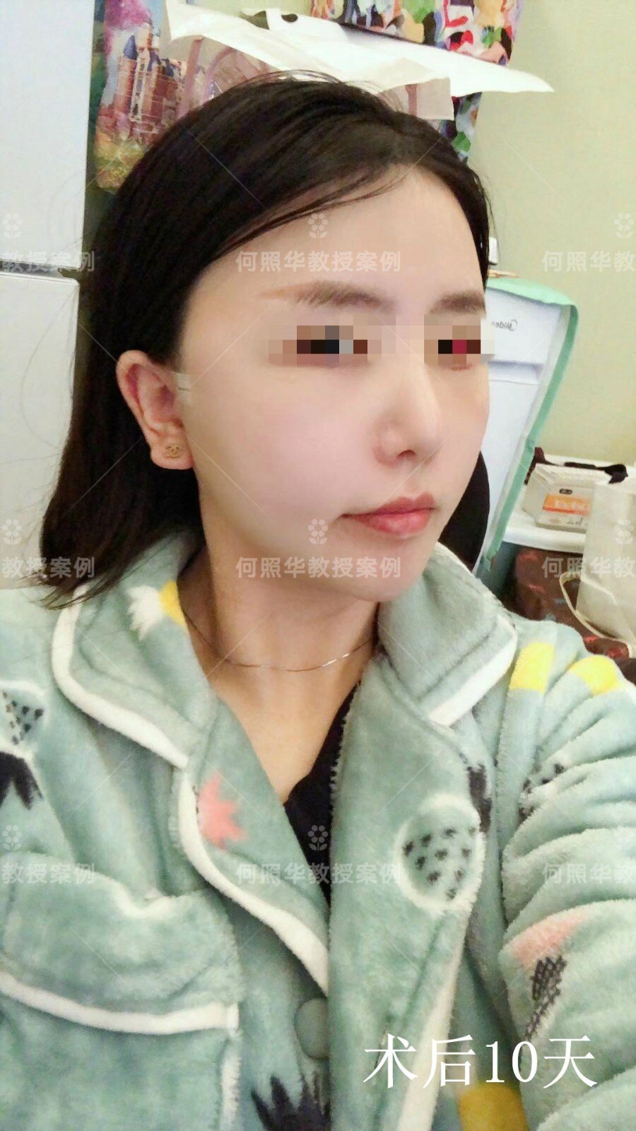 代张力带固定 颧骨颧弓缩小术后10天 变化超明显 下颌整形 下颌整形