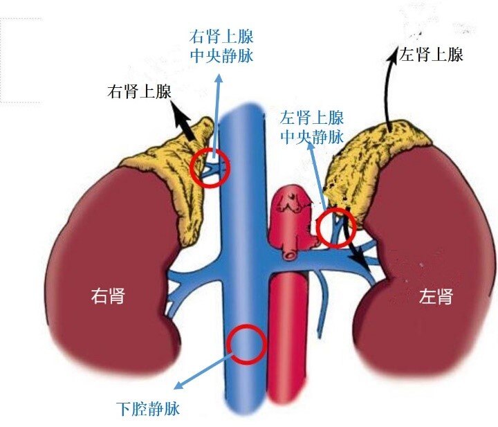 圖中紅圈所示為avs各取血點左右腎上腺中央靜脈造影明確定位因為