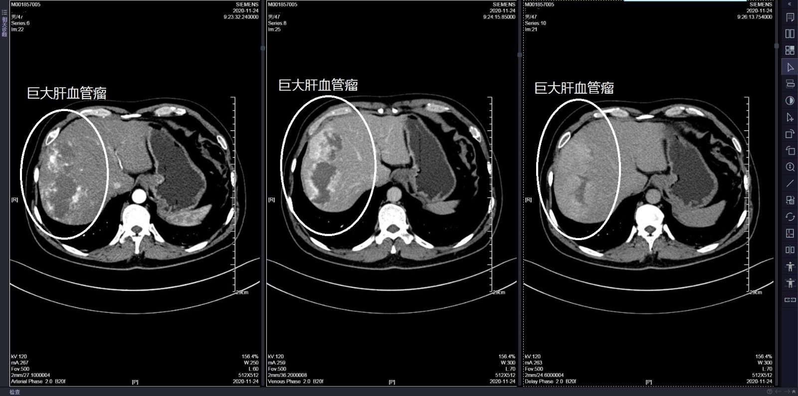 肝血管瘤影像图片