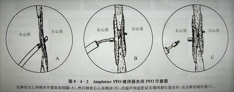 卵圆孔未闭如何治疗