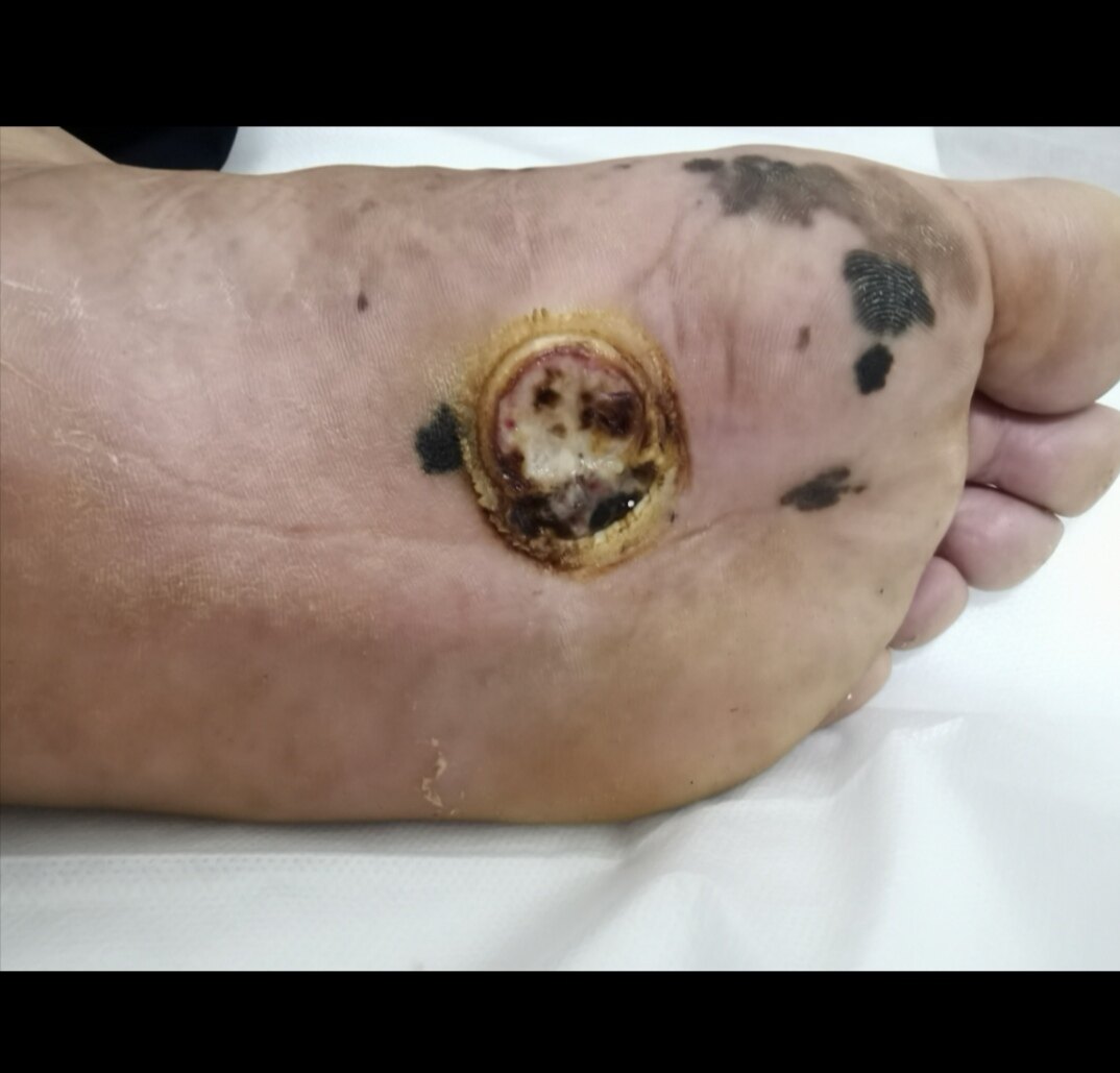 恶性黑色素瘤图片_黑色恶性素瘤严重性_恶性黑素瘤是什么意思