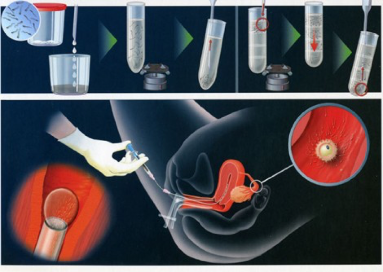 ai分夫精人工授精(aih)和供精(非配偶)人工授精(aid).