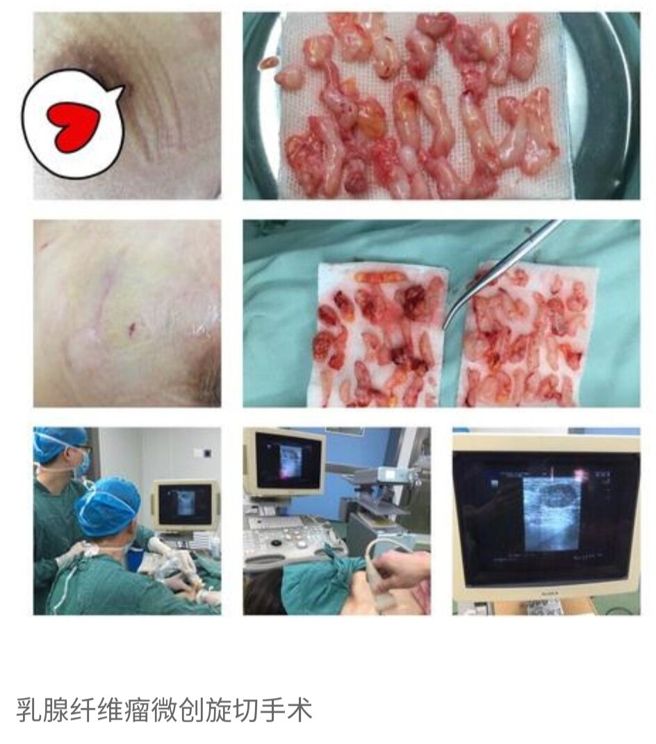 乳腺纤维瘤严不严重 对女性危害不可忽视 凤凰网