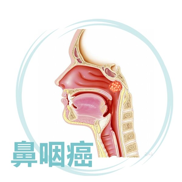 尽早发现鼻咽癌 鼻咽癌 鼻咽癌 尽早发现鼻咽癌 鼻咽癌 鼻咽癌