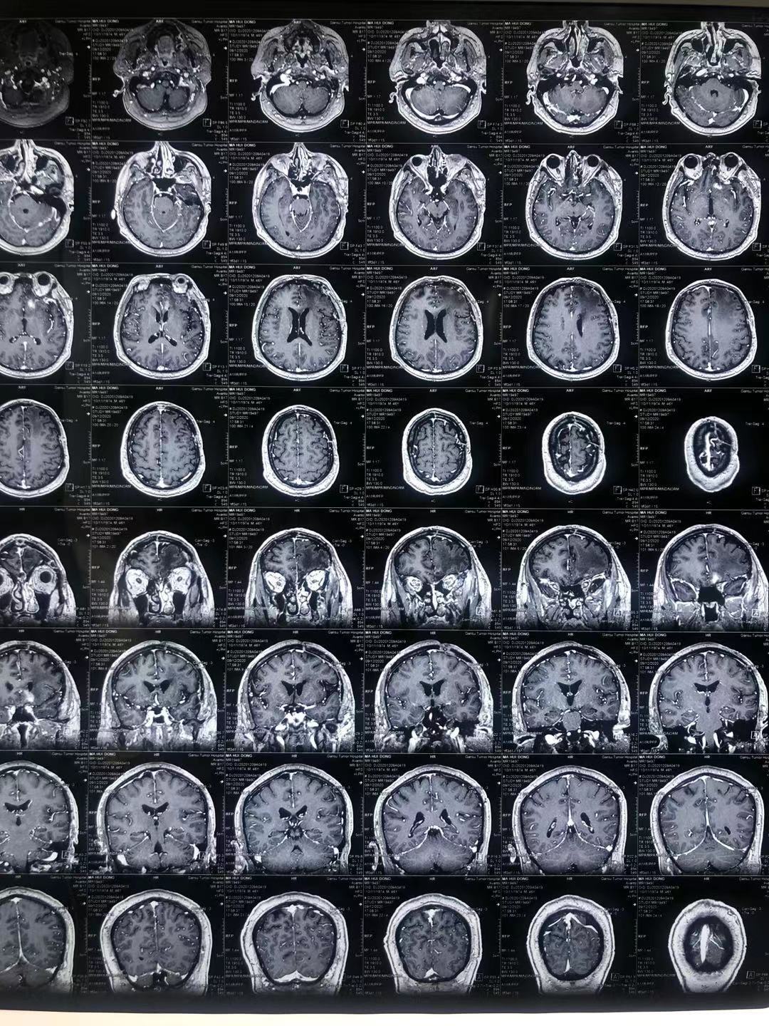 可以治好吗?_淋巴瘤_介绍_治疗方式 - 好大夫在线