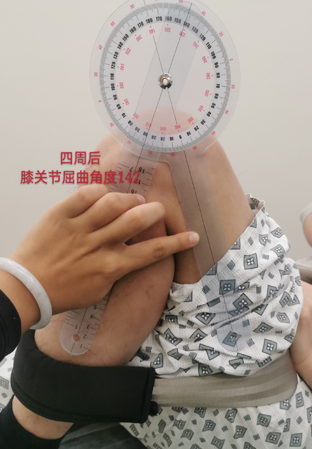 无痛化康复:关节粘连患者的福音