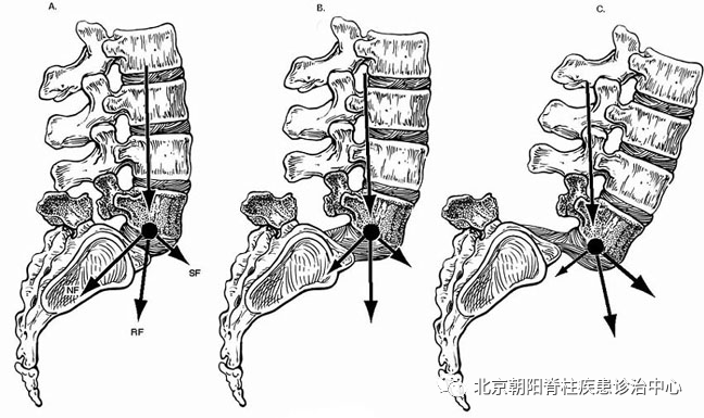 腰椎滑脫 - 好大夫在線