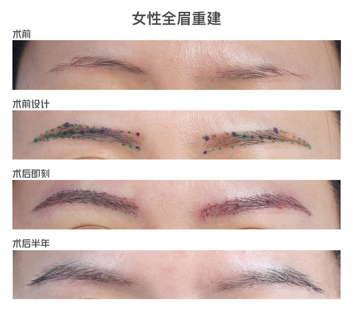 女性全美重建术丨案例分享 植发 女性全美重建术丨案例分享 植发