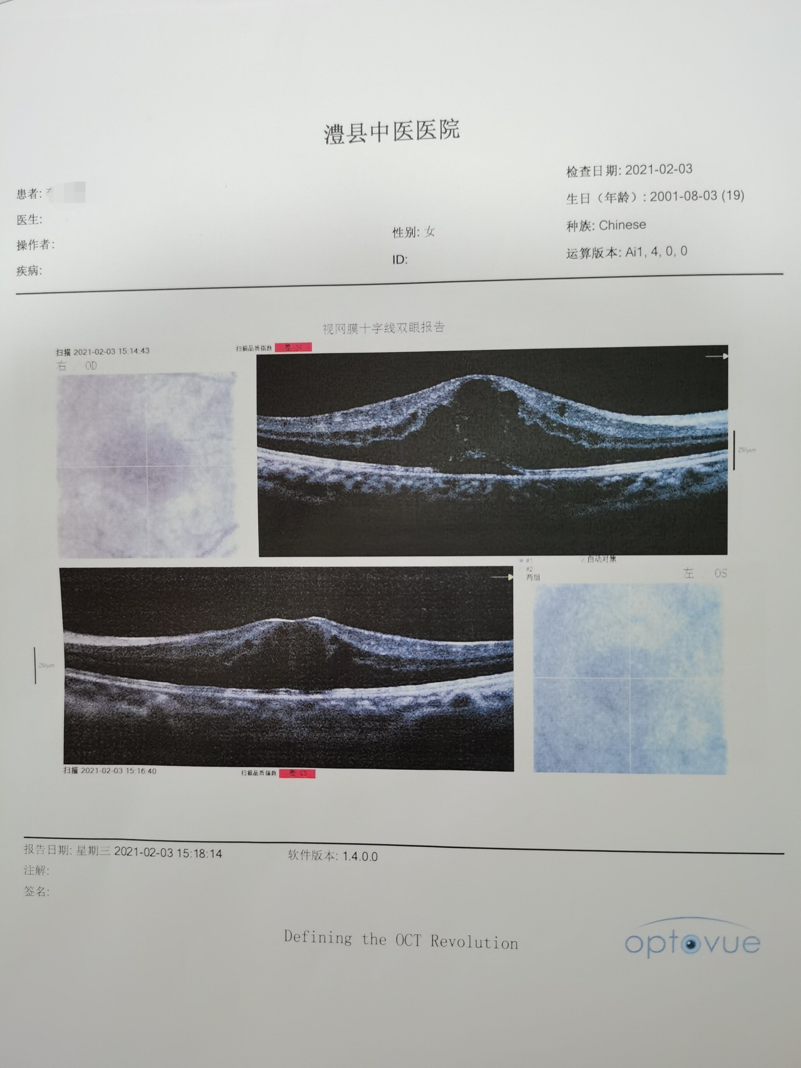 玻璃体出血超声报告图片