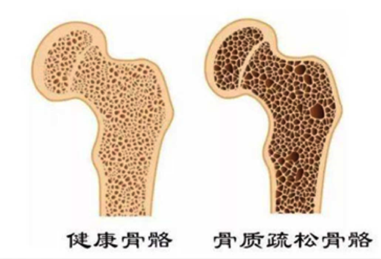 骨质疏松多久恢复最好 y4YBAGA84B6AJj3iAAUdO-MgFUI994.png?_ms_=94b5