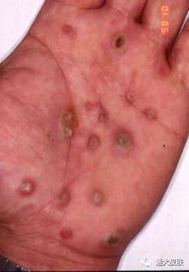 遗传梅毒婴儿症状图片图片