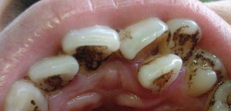 喝茶,喝咖啡,喝带色素的饮料以及食物其他颜色较重的食物引起的牙齿