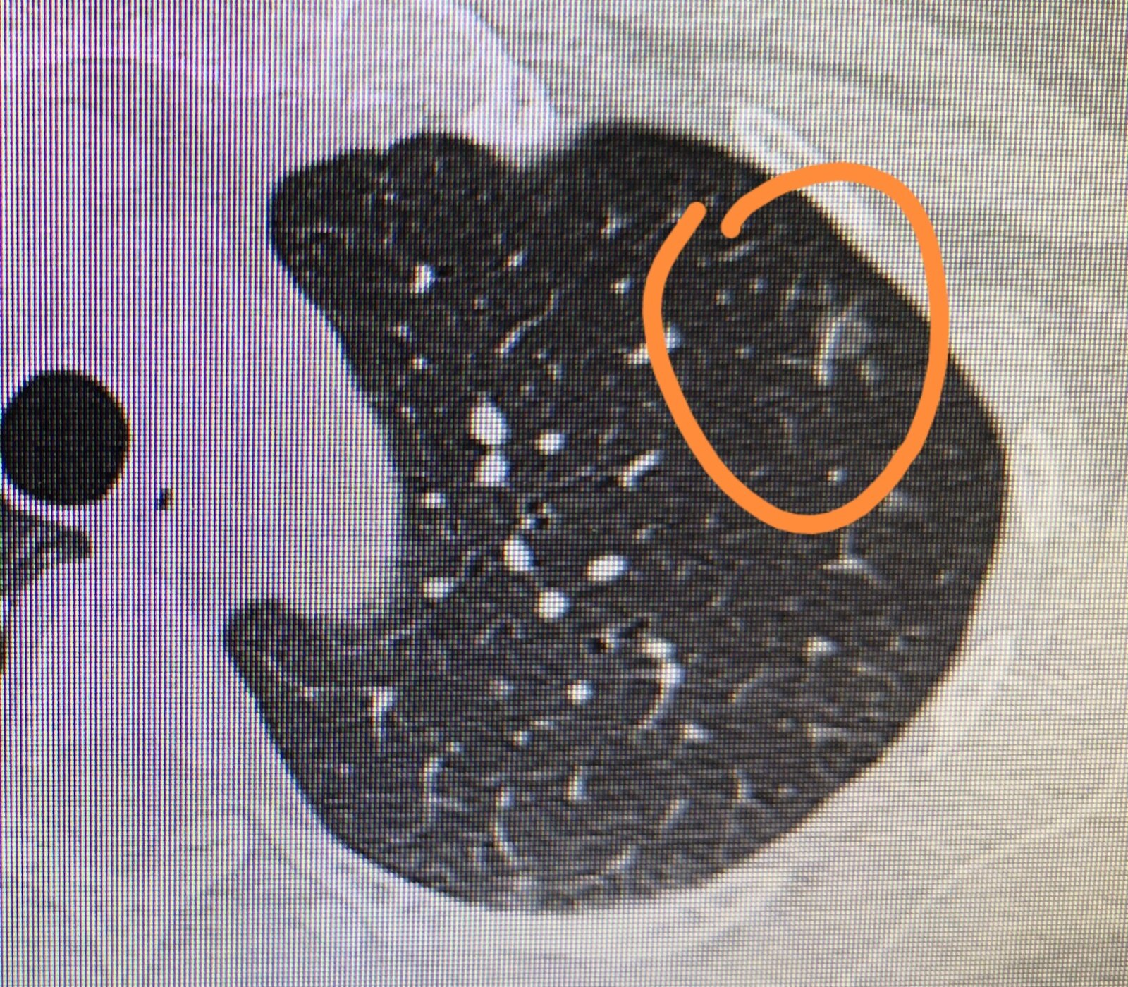 同样是左上肺小结节,为什么我太太只需要定期观察,而我的却需要手术