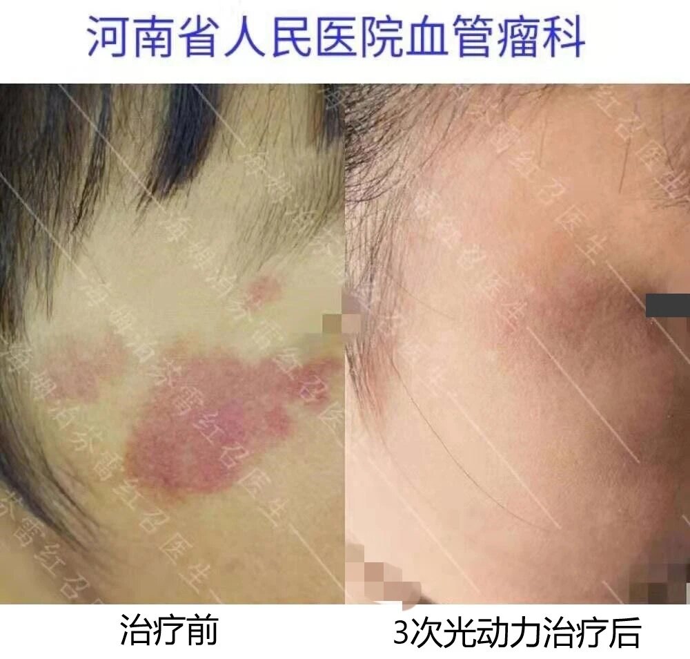 毛细血管畸形鲜红斑痣