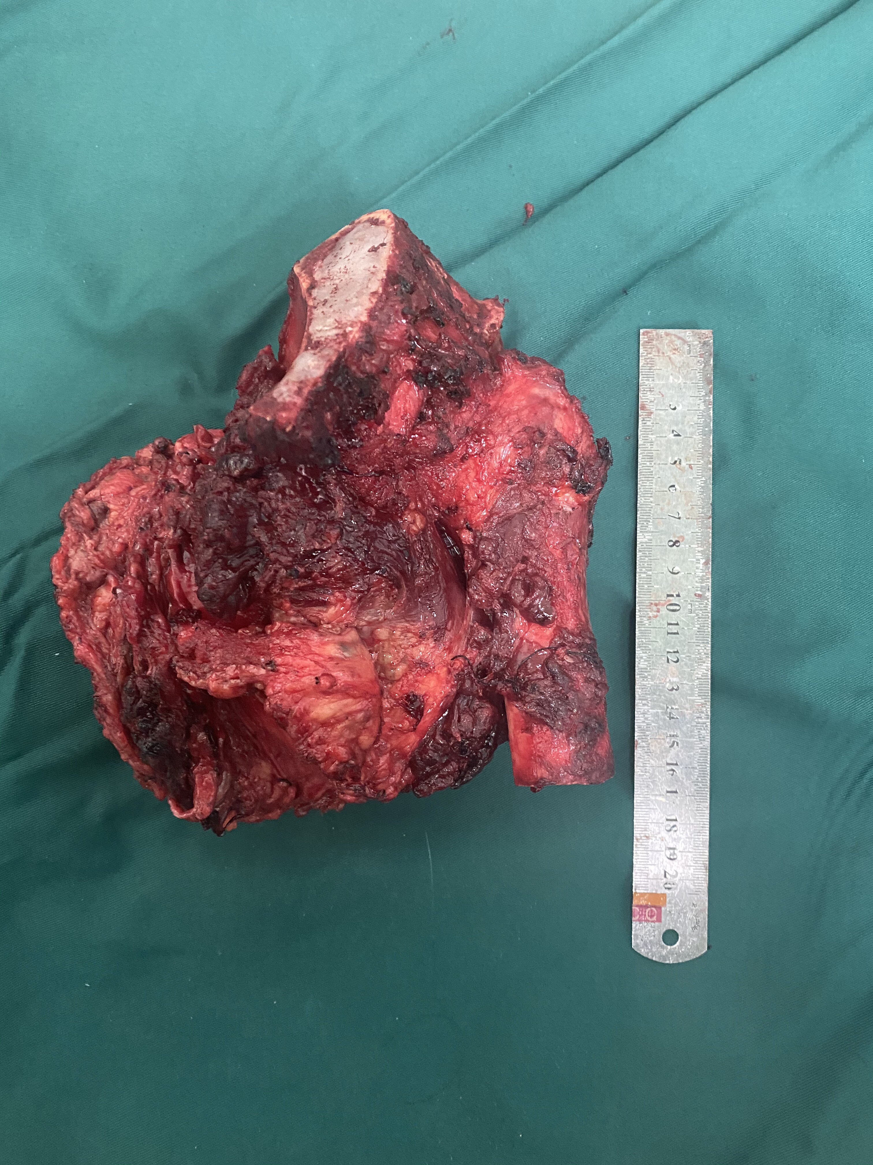 一例复杂骨盆肿瘤的保肢手术治疗 - 好大夫在线