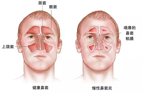 正常鼻窦与鼻窦炎图片图片