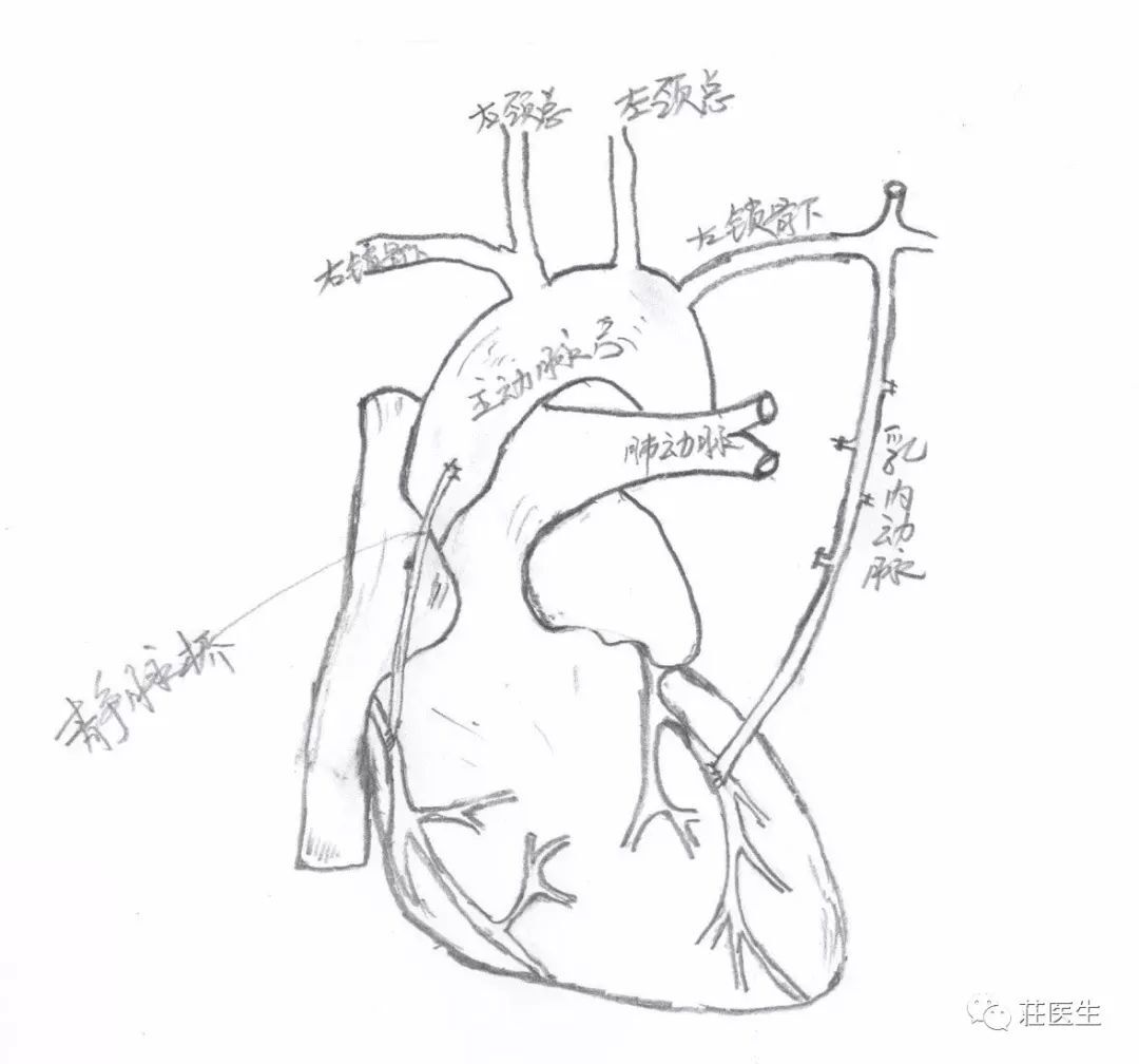 胸廓内动脉 乳内动脉图片