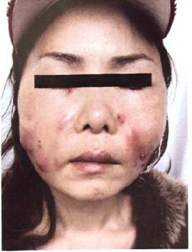 面部注射美容后感染——分枝杆菌感染_注射美容_注射