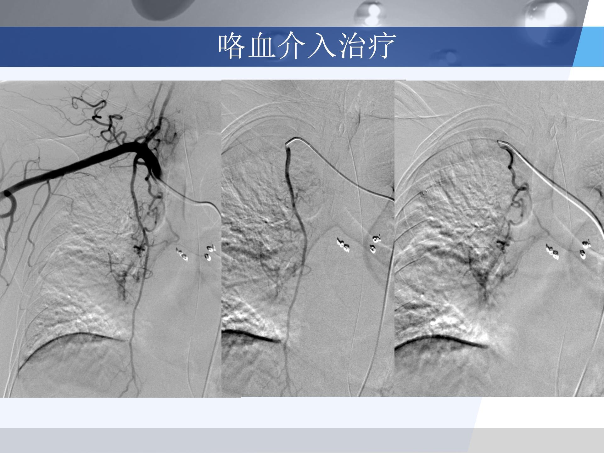 广医附一院-咯血病例汇报 [自动保存的]_09.jpg