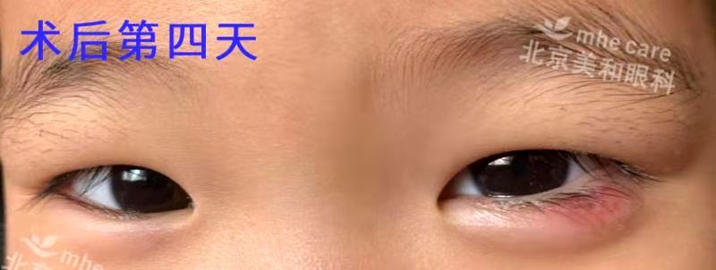 莫把霰粒肿当麦粒肿延误治疗 Eos超脉冲新疗法非手术治疗 霰粒肿 饮食运动 症状