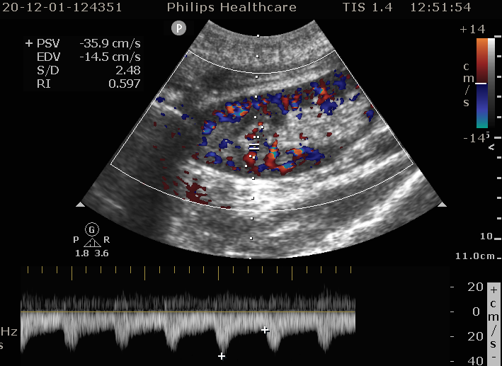 移植肾的超声表现 - 好大夫在线