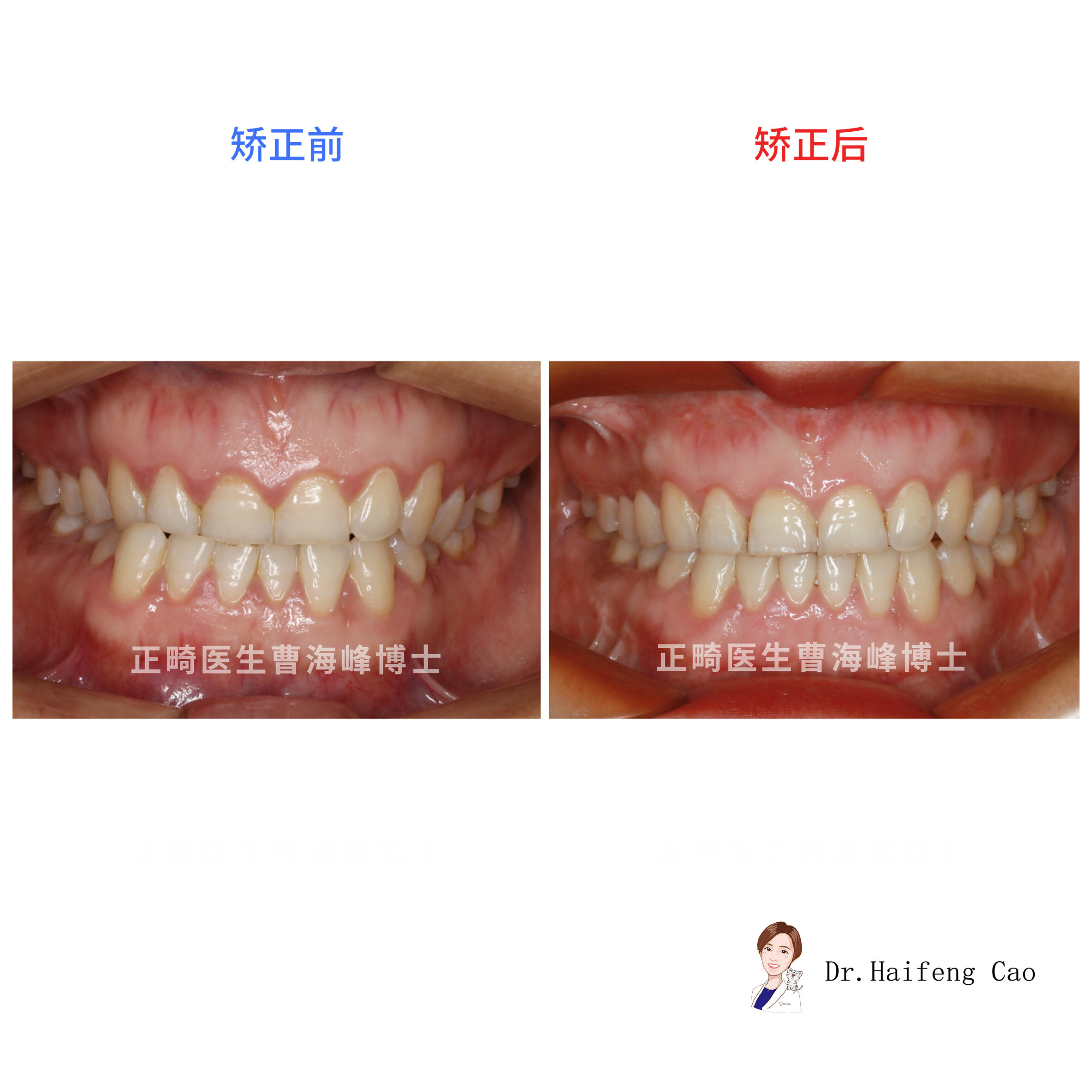 【隐形正畸联合正颌治疗骨性偏颌】_牙颌畸形_牙颌畸形治疗方式 - 好