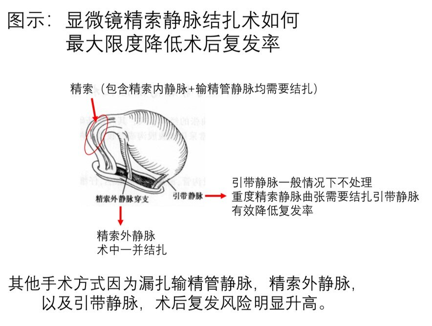 显微镜手术对于非重度患者来说,常规结扎精索内静脉,精索外静脉