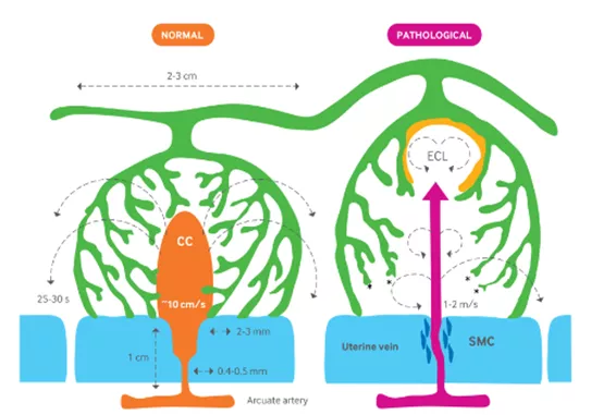 子宫螺旋动脉重铸障碍病理过程包括:目前研究发现可能与子痫前期发病