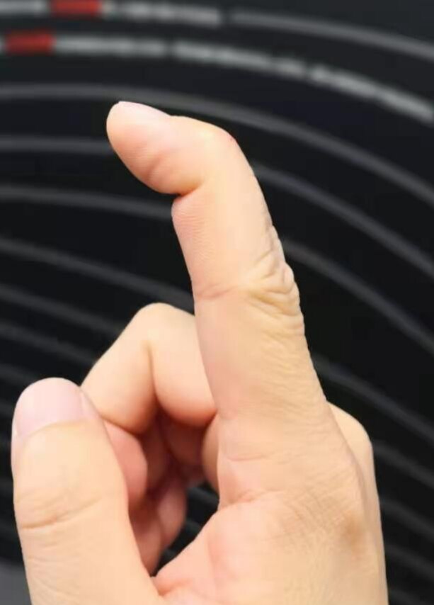 锤状指 末节手指受伤后无法伸直 的科普指导 锤状指 末节手指受伤后无法伸直 的科普指导