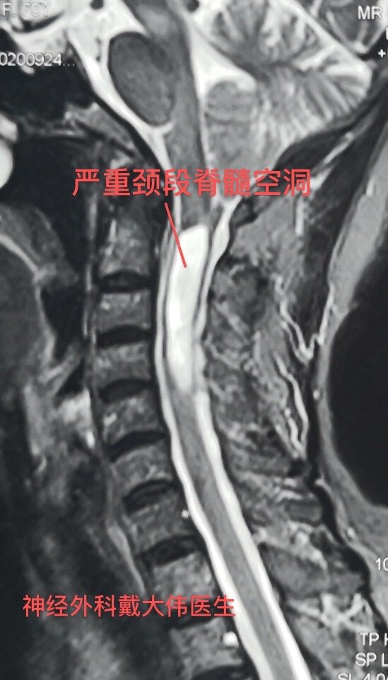脊髓空洞症常问题解答:认识,诊断和规范化治疗_脊髓空洞症_介绍_发病