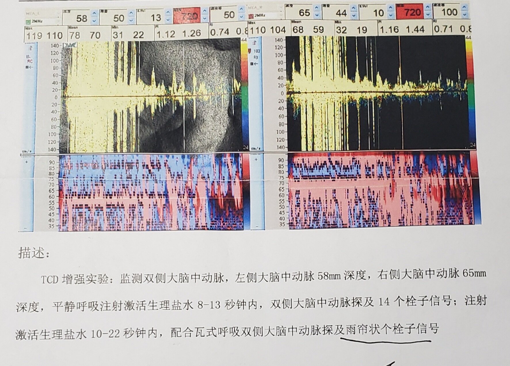 心腔内超声(ice),经食道超声(tee)在pfo相关疾病诊治中,超声心动图