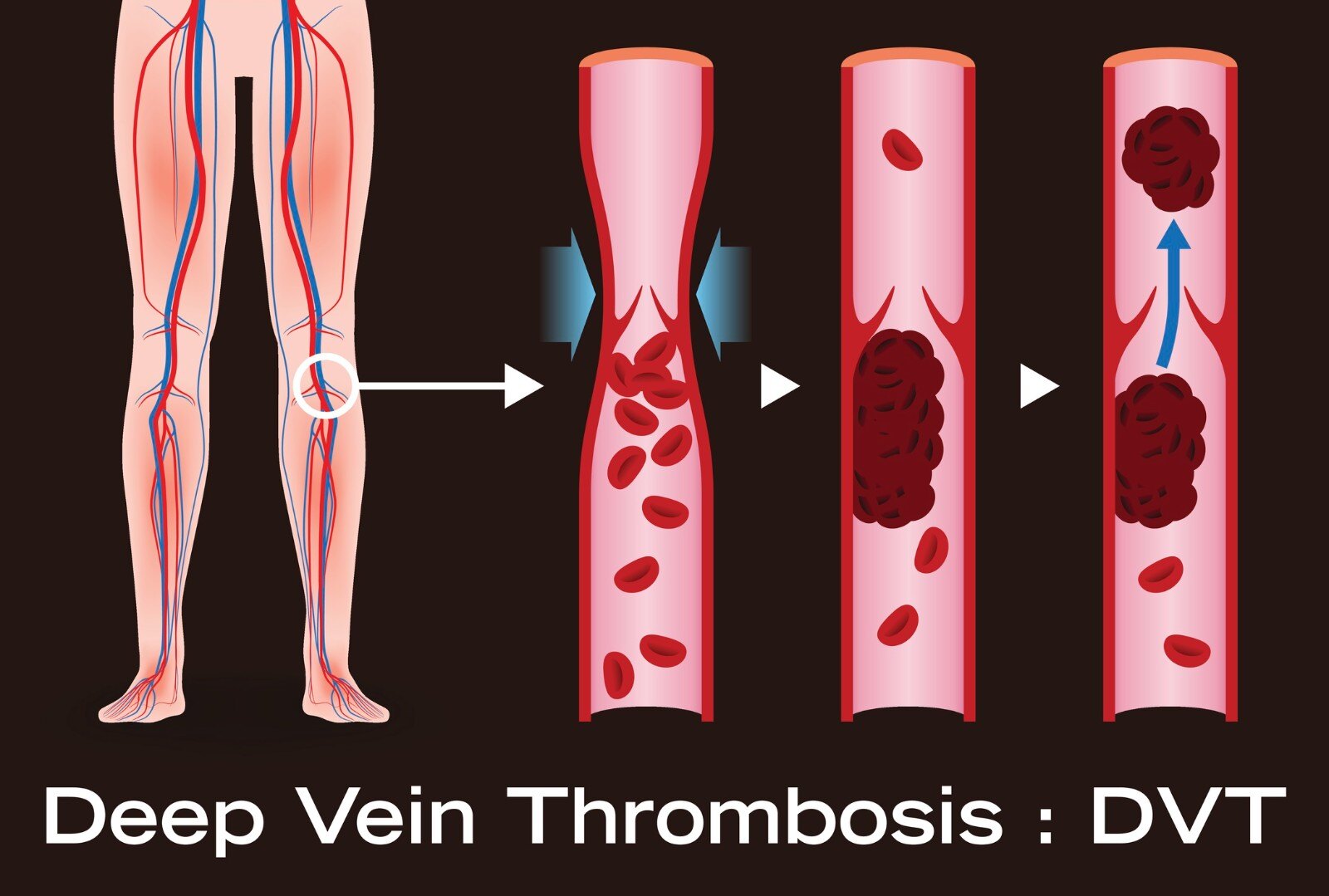 deep-vein-thrombosis-841813664.jpg